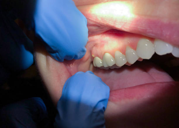 Best Knocked-Out Tooth (Avulsed Tooth) Treatment in Hinton, OK